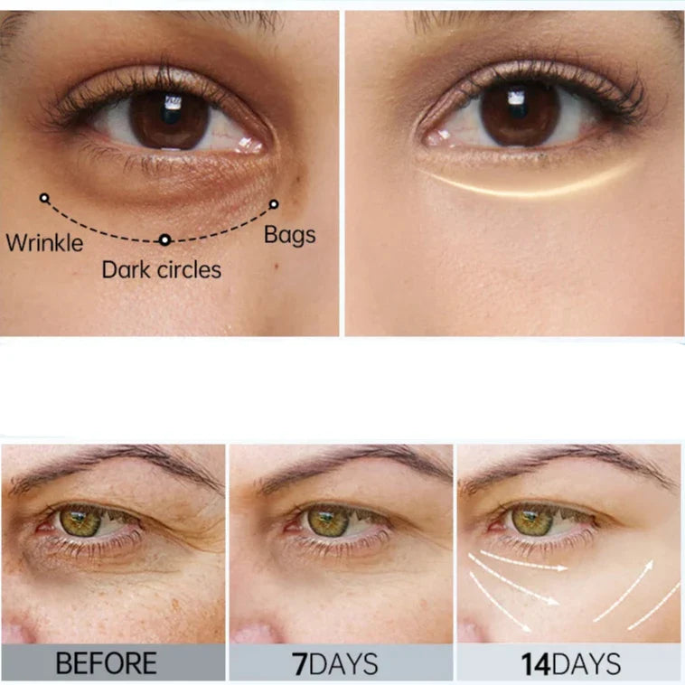 Comparaison avant et après des traitements du contour des yeux pour les cernes et les rides.