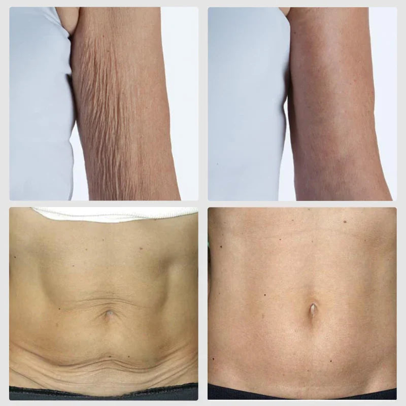 Comparaison avant et après montrant l’amélioration de la texture de la peau sur les bras et l’abdomen.