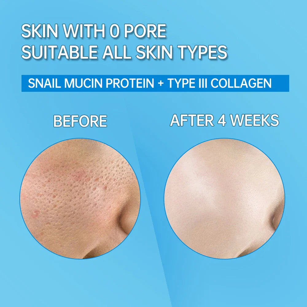 Comparaison avant et après de la texture de la peau montrant les résultats du traitement de réduction des pores.