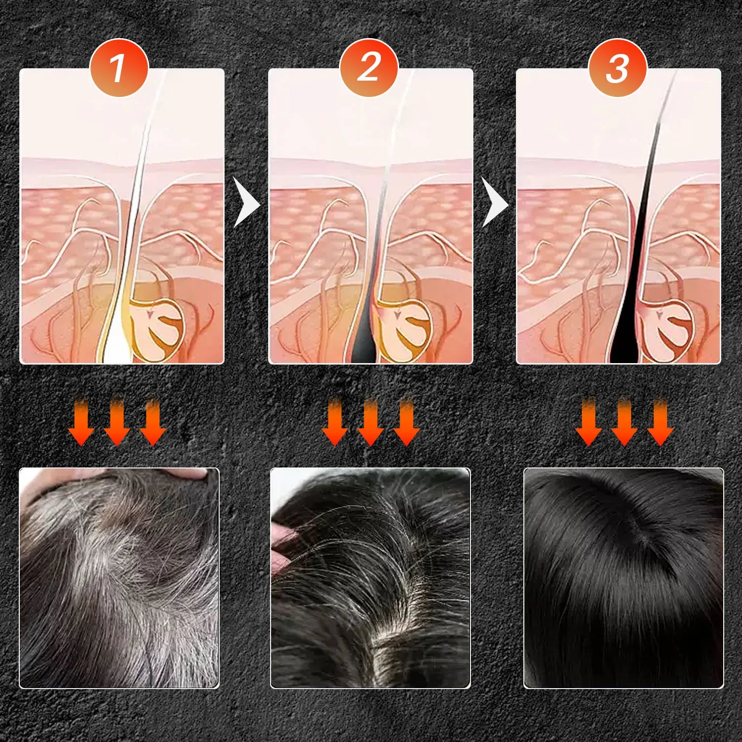 Schéma médical montrant les étapes du traitement du follicule pileux et ses effets sur l’aspect du cuir chevelu.